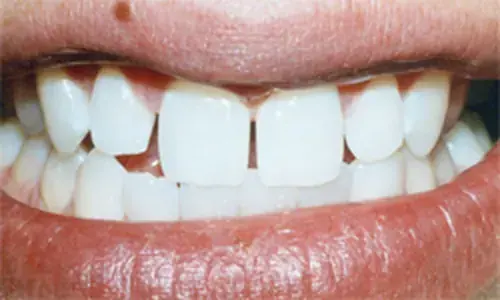 A patient&rsquo;s chipped and uneven front teeth before porcelain veneers