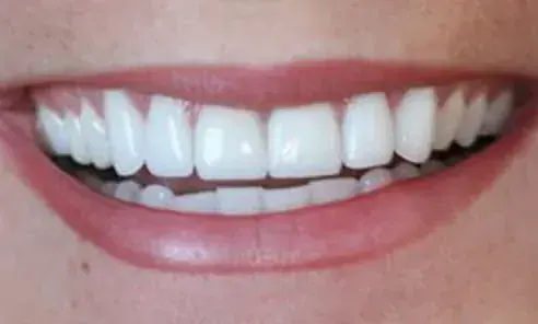 The same patient&rsquo;s smile after treatment at Artistry Smile Center